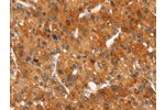 The image on the left is immunohistochemistry of paraffin-embedded Human liver cancer tissue using CSB-PA582009(CLEC6A Antibody) at dilution 1/20, on the right is treated with synthetic peptide. (Original magnification: 