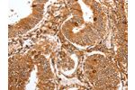 The image on the left is immunohistochemistry of paraffin-embedded Human cervical cancer tissue using CSB-PA582057(FOXO3 Antibody) at dilution 1/22, on the right is treated with synthetic peptide. (Original magnification: 