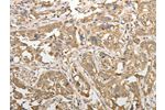 The image on the left is immunohistochemistry of paraffin-embedded Human esophagus cancer tissue using CSB-PA582160(ADHFE1 Antibody) at dilution 1/50, on the right is treated with synthetic peptide. (Original magnification: 