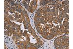 The image on the left is immunohistochemistry of paraffin-embedded Human ovarian cancer tissue using CSB-PA582168(ADAMTS15 Antibody) at dilution 1/60, on the right is treated with fusion protein. (Original magnification: 