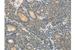 The image on the left is immunohistochemistry of paraffin-embedded Human thyroid cancer tissue using CSB-PA582291(ABCC12 Antibody) at dilution 1/10, on the right is treated with synthetic peptide. (Original magnification: 