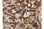 The image is immunohistochemistry of paraffin-embedded Human thyroid cancer tissue using CSB-PA582788(BCL2L12 Antibody) at dilution 1/20. (Original magnification: 