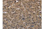 The image on the left is immunohistochemistry of paraffin-embedded Human liver cancer tissue using CSB-PA583154(FABP2 Antibody) at dilution 1/40, on the right is treated with synthetic peptide. (Original magnification: 