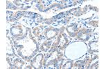 The image on the left is immunohistochemistry of paraffin-embedded Human thyroid cancer tissue using CSB-PA583376(ADAM21 Antibody) at dilution 1/15, on the right is treated with fusion protein. (Original magnification: 