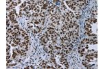 The image on the left is immunohistochemistry of paraffin-embedded Human ovarian cancer tissue using CSB-PA583825(ELN Antibody) at dilution 1/50, on the right is treated with fusion protein. (Original magnification: 