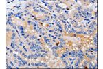 The image on the left is immunohistochemistry of paraffin-embedded Human thyroid cancer tissue using CSB-PA584015(CDK10 Antibody) at dilution 1/25, on the right is treated with fusion protein. (Original magnification: 