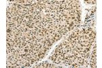 The image on the left is immunohistochemistry of paraffin-embedded Human liver cancer tissue using CSB-PA584378(ANGPT4 Antibody) at dilution 1/70, on the right is treated with synthetic peptide. (Original magnification: 