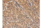The image on the left is immunohistochemistry of paraffin-embedded Human gastic cancer tissue using CSB-PA584418(AIMP1 Antibody) at dilution 1/40, on the right is treated with synthetic peptide. (Original magnification: 