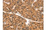 The image on the left is immunohistochemistry of paraffin-embedded Human liver cancer tissue using CSB-PA584449(EPPIN Antibody) at dilution 1/25, on the right is treated with synthetic peptide. (Original magnification: 