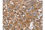 The image on the left is immunohistochemistry of paraffin-embedded Human thyroid cancer tissue using CSB-PA584549(COX5A Antibody) at dilution 1/25, on the right is treated with synthetic peptide. (Original magnification: 