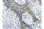 The image on the left is immunohistochemistry of paraffin-embedded Human esophagus cancer tissue using CSB-PA584727(CHRDL1 Antibody) at dilution 1/35, on the right is treated with synthetic peptide. (Original magnification: 
