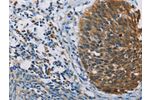 The image on the left is immunohistochemistry of paraffin-embedded Human tonsil tissue using CSB-PA584842(FXYD1 Antibody) at dilution 1/60, on the right is treated with fusion protein. (Original magnification: 