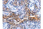 The image on the left is immunohistochemistry of paraffin-embedded Human esophagus cancer tissue using CSB-PA584850(CLCA4 Antibody) at dilution 1/15, on the right is treated with fusion protein. (Original magnification: 