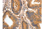 The image on the left is immunohistochemistry of paraffin-embedded Human colon cancer tissue using CSB-PA585175(BAIAP2 Antibody) at dilution 1/30, on the right is treated with fusion protein. (Original magnification: 