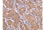 The image on the left is immunohistochemistry of paraffin-embedded Human gastic cancer tissue using CSB-PA585322(ETFB Antibody) at dilution 1/25, on the right is treated with synthetic peptide. (Original magnification: 