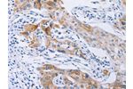The image on the left is immunohistochemistry of paraffin-embedded Human lung cancer tissue using CSB-PA585818(CDC27 Antibody) at dilution 1/40, on the right is treated with synthetic peptide. (Original magnification: 
