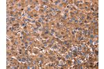 The image on the left is immunohistochemistry of paraffin-embedded Human liver cancer tissue using CSB-PA585877(ERN2 Antibody) at dilution 1/40, on the right is treated with synthetic peptide. (Original magnification: 
