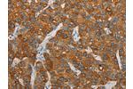 The image on the left is immunohistochemistry of paraffin-embedded Human liver cancer tissue using CSB-PA585956(FOSB Antibody) at dilution 1/20, on the right is treated with synthetic peptide. (Original magnification: 