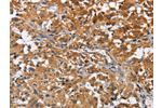 The image on the left is immunohistochemistry of paraffin-embedded Human thyroid cancer tissue using CSB-PA586126(ATP1B2 Antibody) at dilution 1/30, on the right is treated with fusion protein. (Original magnification: 