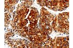 The image is immunohistochemistry of paraffin-embedded Human liver cancer tissue using CSB-PA586799(COX19 Antibody) at dilution 1/50. (Original magnification: 