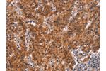 The image on the left is immunohistochemistry of paraffin-embedded Human gastic cancer tissue using CSB-PA587164(GNAT3 Antibody) at dilution 1/15, on the right is treated with synthetic peptide. (Original magnification: 
