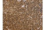 The image on the left is immunohistochemistry of paraffin-embedded Human cervical cancer tissue using CSB-PA587286(BRAF Antibody) at dilution 1/30, on the right is treated with synthetic peptide. (Original magnification: 