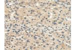 The image on the left is immunohistochemistry of paraffin-embedded Human liver cancer tissue using CSB-PA587496(CHRNA1 Antibody) at dilution 1/20, on the right is treated with synthetic peptide. (Original magnification: 