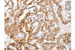 The image on the left is immunohistochemistry of paraffin-embedded Human thyroid cancer tissue using CSB-PA587551(ACY3 Antibody) at dilution 1/35, on the right is treated with fusion protein. (Original magnification: 