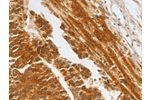 The image on the left is immunohistochemistry of paraffin-embedded Human liver cancer tissue using CSB-PA587680(CFHR1 Antibody) at dilution 1/30, on the right is treated with fusion protein. (Original magnification: 