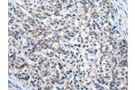 The image on the left is immunohistochemistry of paraffin-embedded Human esophagus cancer tissue using CSB-PA588410(EIF4EBP1 Antibody) at dilution 1/30, on the right is treated with fusion protein. (Original magnification: 