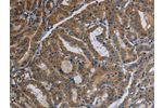 The image on the left is immunohistochemistry of paraffin-embedded Human thyroid cancer tissue using CSB-PA589232(FAAH Antibody) at dilution 1/40, on the right is treated with fusion protein. (Original magnification: 