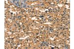 The image on the left is immunohistochemistry of paraffin-embedded Human thyroid cancer tissue using CSB-PA589353(APC Antibody) at dilution 1/25, on the right is treated with synthetic peptide. (Original magnification: 