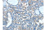 The image on the left is immunohistochemistry of paraffin-embedded Human thyroid cancer tissue using CSB-PA589884(ADRA1A Antibody) at dilution 1/60, on the right is treated with synthetic peptide. (Original magnification: 