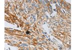 The image on the left is immunohistochemistry of paraffin-embedded Human esophagus cancer tissue using CSB-PA590086(NTF3 Antibody) at dilution 1/15, on the right is treated with fusion protein. (Original magnification: 