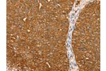The image on the left is immunohistochemistry of paraffin-embedded Human breast cancer tissue using CSB-PA590986(ABCC8 Antibody) at dilution 1/40, on the right is treated with synthetic peptide. (Original magnification: 