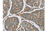 The image on the left is immunohistochemistry of paraffin-embedded Human breast cancer tissue using CSB-PA591028(CYP11B1 Antibody) at dilution 1/25, on the right is treated with fusion protein. (Original magnification: 