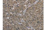 The image on the left is immunohistochemistry of paraffin-embedded Human esophagus cancer tissue using CSB-PA591518(CLPS Antibody) at dilution 1/40, on the right is treated with fusion protein. (Original magnification: 