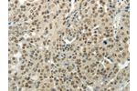 The image on the left is immunohistochemistry of paraffin-embedded Human breast cancer tissue using CSB-PA591538(BAZ1B Antibody) at dilution 1/35, on the right is treated with synthetic peptide. (Original magnification: 