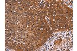 The image on the left is immunohistochemistry of paraffin-embedded Human cervical cancer tissue using CSB-PA591907(CDC37L1 Antibody) at dilution 1/60, on the right is treated with fusion protein. (Original magnification: 
