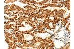 The image on the left is immunohistochemistry of paraffin-embedded Human thyroid cancer tissue using CSB-PA592293(DIABLO Antibody) at dilution 1/70, on the right is treated with fusion protein. (Original magnification: 