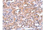 The image on the left is immunohistochemistry of paraffin-embedded Human thyroid cancer tissue using CSB-PA592424(FAT1 Antibody) at dilution 1/40, on the right is treated with synthetic peptide. (Original magnification: 