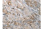 The image on the left is immunohistochemistry of paraffin-embedded Human gastic cancer tissue using CSB-PA592744(CST3 Antibody) at dilution 1/50, on the right is treated with synthetic peptide. (Original magnification: 