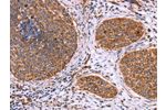 The image on the left is immunohistochemistry of paraffin-embedded Human cervical cancer tissue using CSB-PA593413(CLUAP1 Antibody) at dilution 1/50, on the right is treated with fusion protein. (Original magnification: 