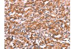 The image on the left is immunohistochemistry of paraffin-embedded Human thyroid cancer tissue using CSB-PA593948(GAS8 Antibody) at dilution 1/30, on the right is treated with synthetic peptide. (Original magnification: 