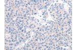 The image on the left is immunohistochemistry of paraffin-embedded Human liver cancer tissue using CSB-PA594444(GCK Antibody) at dilution 1/20, on the right is treated with synthetic peptide. (Original magnification: 