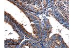 The image on the left is immunohistochemistry of paraffin-embedded Human cervical cancer tissue using CSB-PA594474(FPR2 Antibody) at dilution 1/17, on the right is treated with synthetic peptide. (Original magnification: 