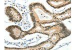 The image on the left is immunohistochemistry of paraffin-embedded Human colon cancer tissue using CSB-PA594692(BCAS2 Antibody) at dilution 1/50, on the right is treated with fusion protein. (Original magnification: 