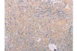 The image on the left is immunohistochemistry of paraffin-embedded Human cervical cancer tissue using CSB-PA595084(ABCF3 Antibody) at dilution 1/30, on the right is treated with fusion protein. (Original magnification: 