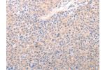 The image on the left is immunohistochemistry of paraffin-embedded Human liver cancer tissue using CSB-PA595124(ACO1 Antibody) at dilution 1/50, on the right is treated with synthetic peptide. (Original magnification: 