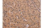 The image on the left is immunohistochemistry of paraffin-embedded Human liver cancer tissue using CSB-PA595607(CSNK1D Antibody) at dilution 1/50, on the right is treated with fusion protein. (Original magnification: 